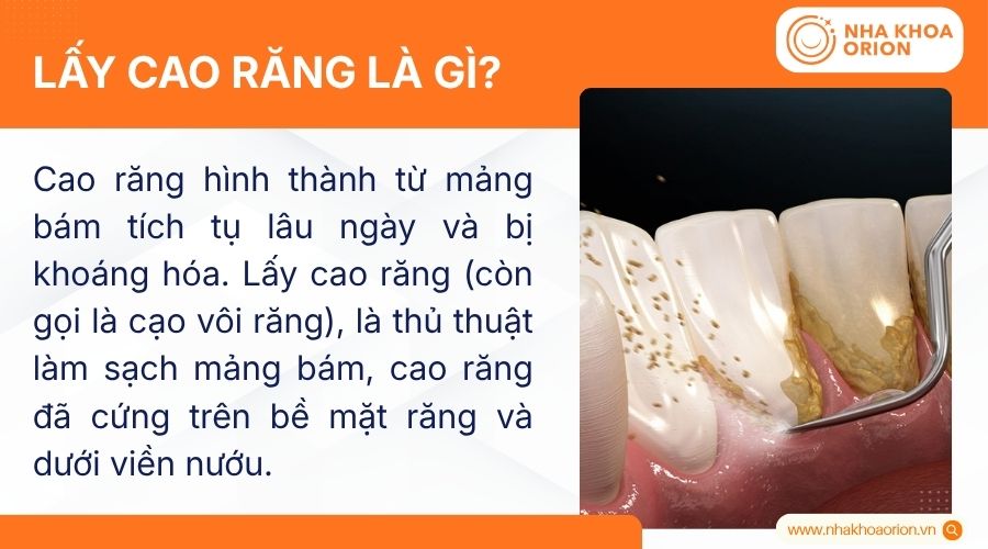 Lấy cao răng l&agrave; g&igrave;?