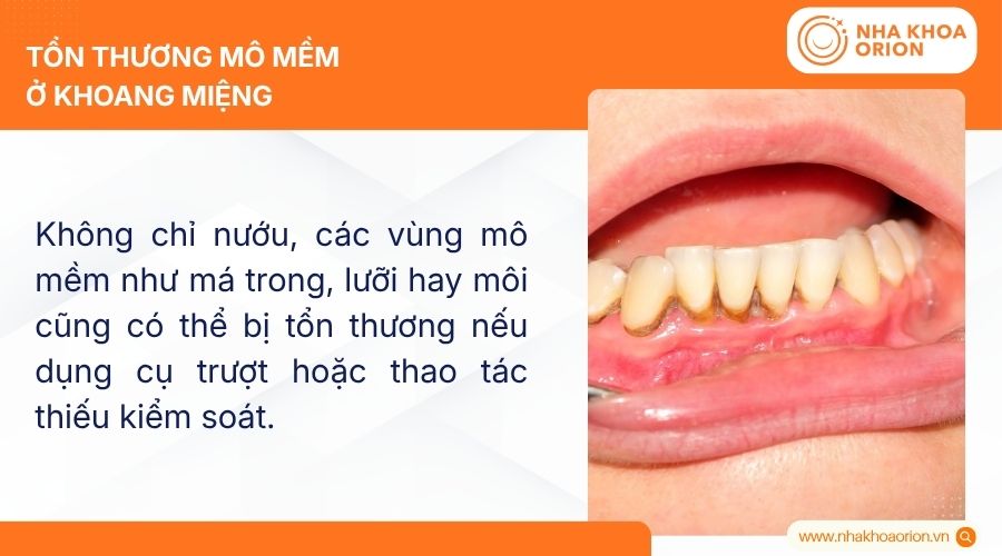 Tổn thương m&ocirc; mềm ở khoang miệng