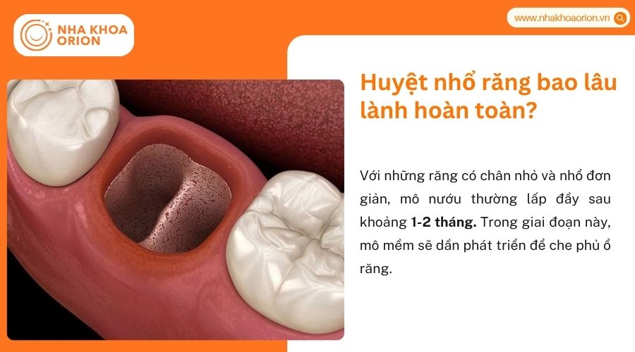 Huyệt nhổ răng bao l&acirc;u l&agrave;nh ho&agrave;n to&agrave;n?