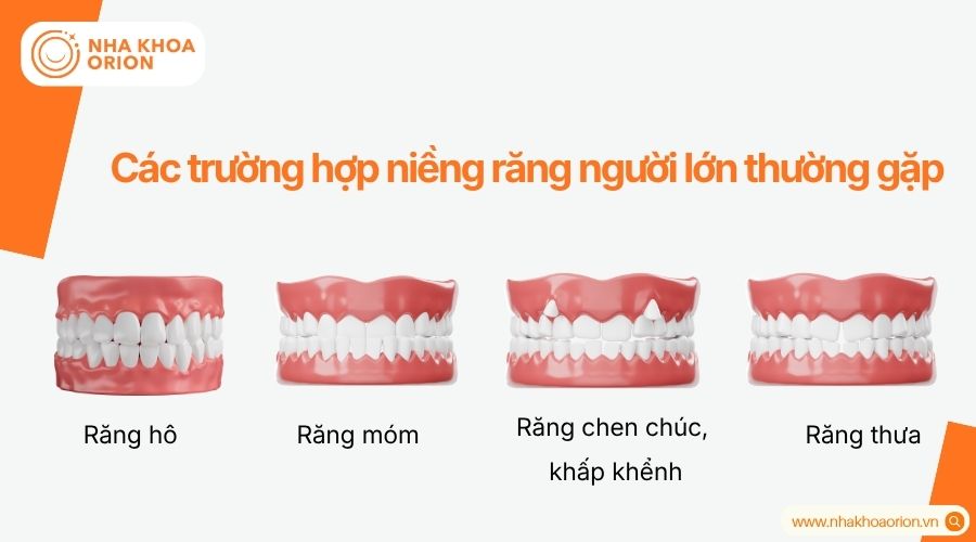 C&aacute;c t&igrave;nh trạng sai lệch răng phổ biến cần can thiệp chỉnh nha