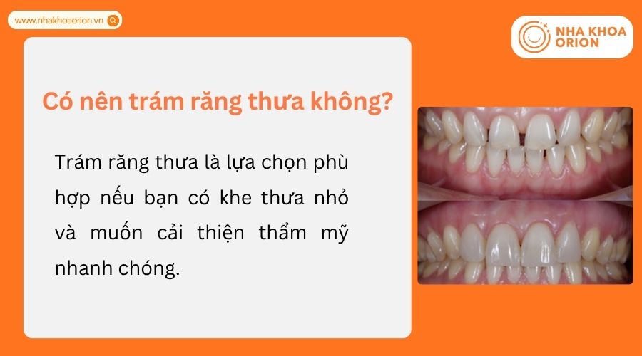 Tr&aacute;m răng thưa ph&ugrave; hợp với răng thưa nhẹ v&agrave; nhu cầu cải thiện thẩm mỹ nhanh