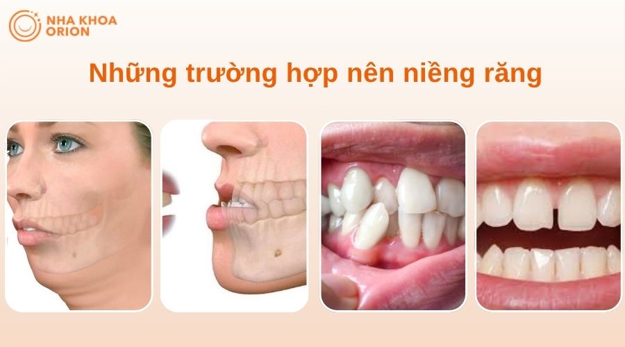 Can thiệp sớm t&igrave;nh trạng răng h&ocirc;, m&oacute;m, khấp khểnh l&agrave; ch&igrave;a kh&oacute;a để ngăn chặn biến chứng v&agrave; bảo vệ sức khỏe răng miệng