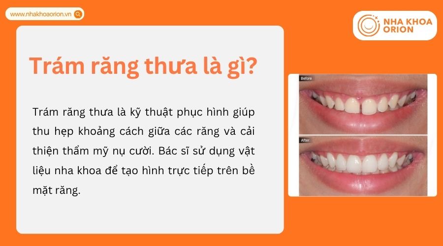 Tr&aacute;m răng thưa gi&uacute;p đ&oacute;ng khe thưa v&agrave; cải thiện thẩm mỹ nụ cười nhanh ch&oacute;ng