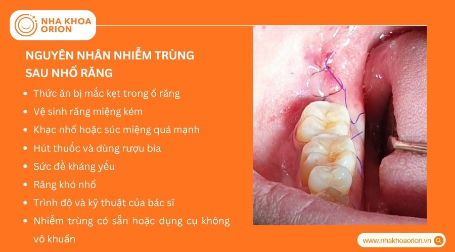 C&aacute;c yếu tố l&agrave;m tăng nguy cơ nhiễm tr&ugrave;ng sau khi nhổ răng
