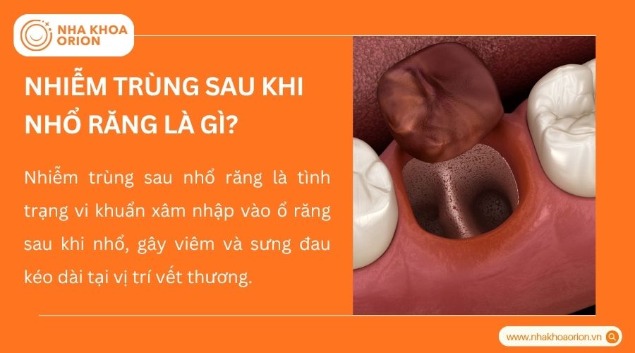 Ổ răng sau nhổ bị vi khuẩn x&acirc;m nhập g&acirc;y vi&ecirc;m v&agrave; sưng đau