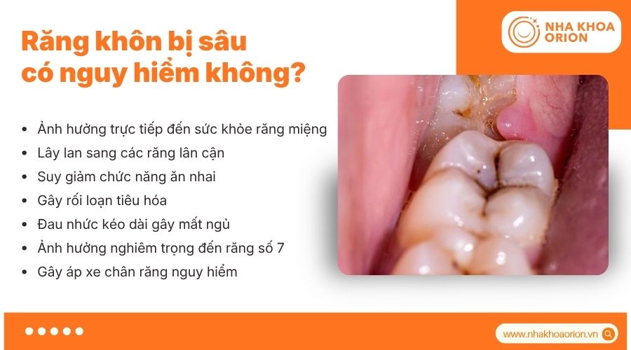 Răng kh&ocirc;n bị s&acirc;u c&oacute; thể g&acirc;y nhiều biến chứng nguy hiểm nếu kh&ocirc;ng điều trị