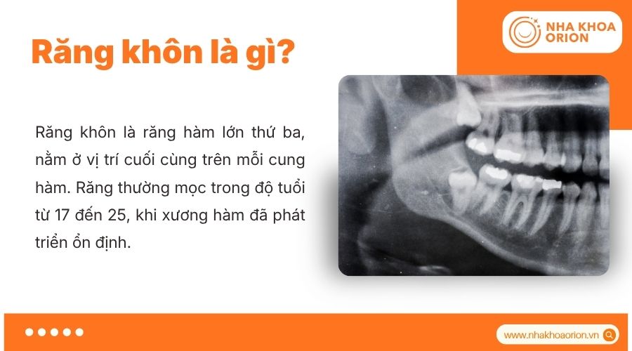 Răng kh&ocirc;n l&agrave; răng h&agrave;m lớn thứ ba mọc muộn ở cuối cung h&agrave;m