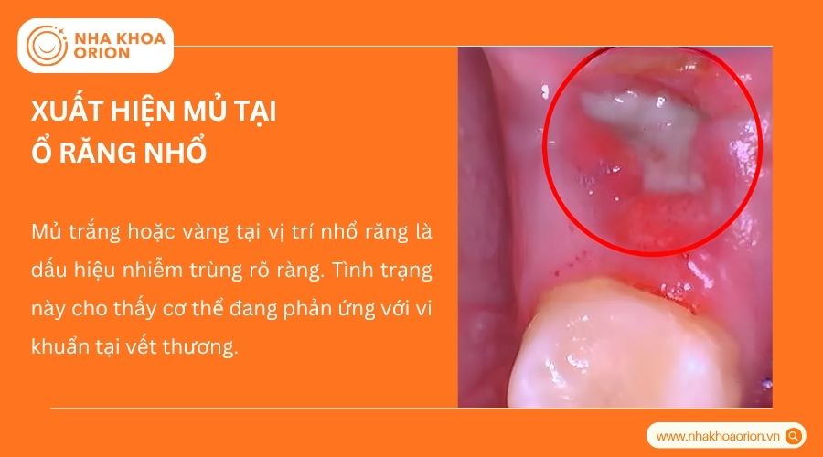 Ổ răng xuất hiện mủ l&agrave; dấu hiệu nhiễm tr&ugrave;ng dễ nhận biết