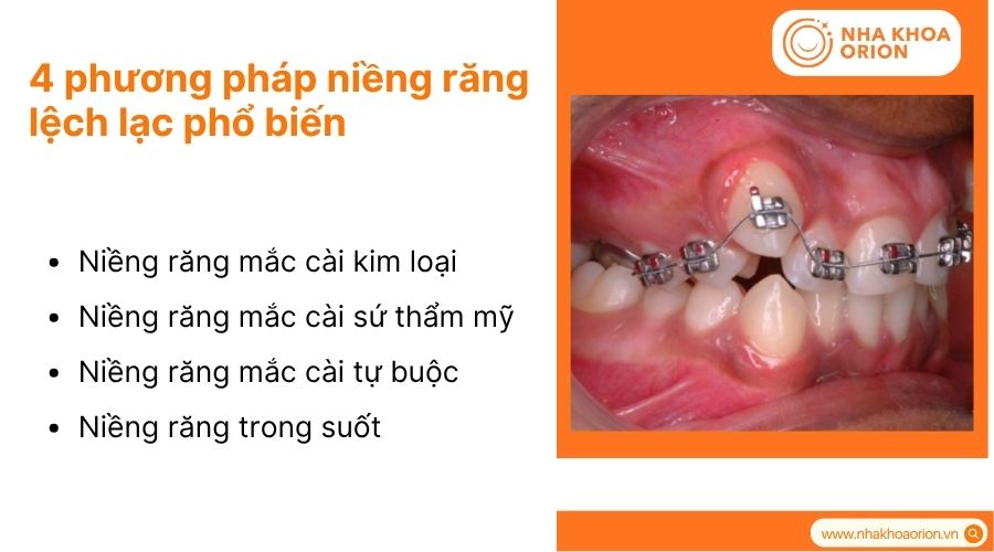 Mỗi phương ph&aacute;p niềng răng c&oacute; đặc điểm ri&ecirc;ng, ph&ugrave; hợp với từng t&igrave;nh trạng cụ thể