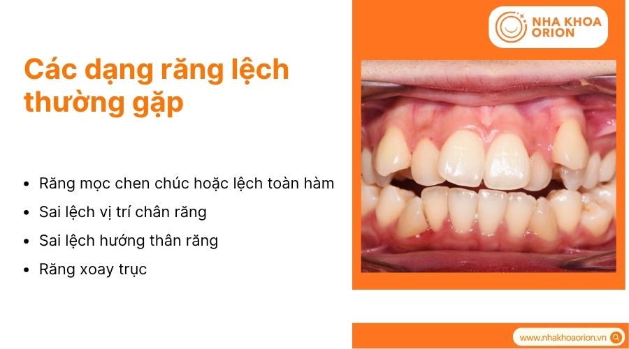 Răng lệch lạc c&oacute; nhiều dạng kh&aacute;c nhau v&agrave; cần được ph&acirc;n loại ch&iacute;nh x&aacute;c trước khi điều trị