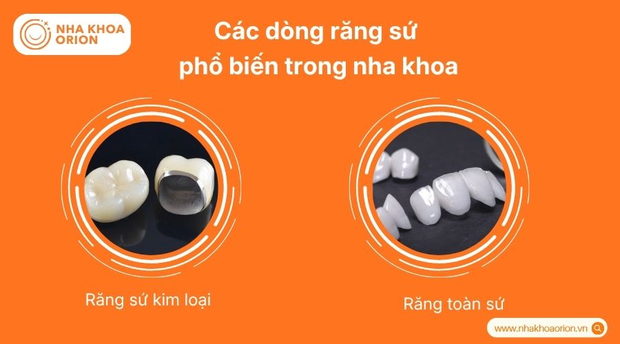 Răng sứ được chia th&agrave;nh hai nh&oacute;m ch&iacute;nh l&agrave; kim loại v&agrave; to&agrave;n sứ