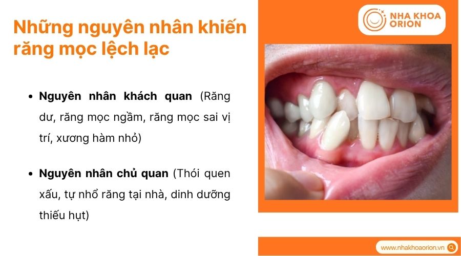 Răng lệch lạc c&oacute; thể do di truyền, th&oacute;i quen xấu hoặc sự ph&aacute;t triển kh&ocirc;ng c&acirc;n đối