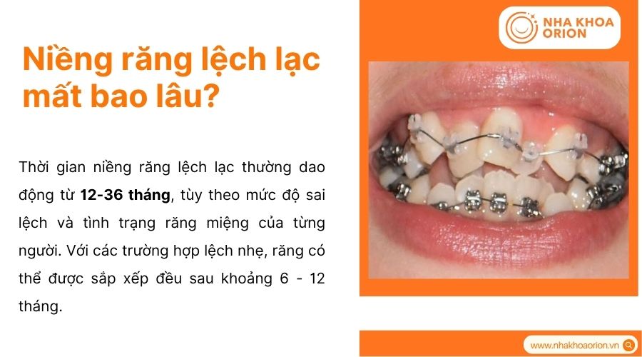 Thời gian niềng răng thay đổi t&ugrave;y v&agrave;o mức độ lệch v&agrave; sự tu&acirc;n thủ điều trị