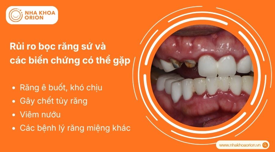 Bọc răng sứ c&oacute; thể g&acirc;y &ecirc; buốt, vi&ecirc;m nướu hoặc biến chứng nếu sai kỹ thuật