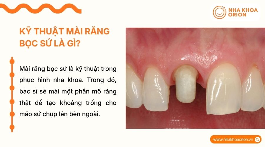 M&agrave;i răng bọc sứ gi&uacute;p tạo trụ răng vững chắc để gắn m&atilde;o sứ thẩm mỹ