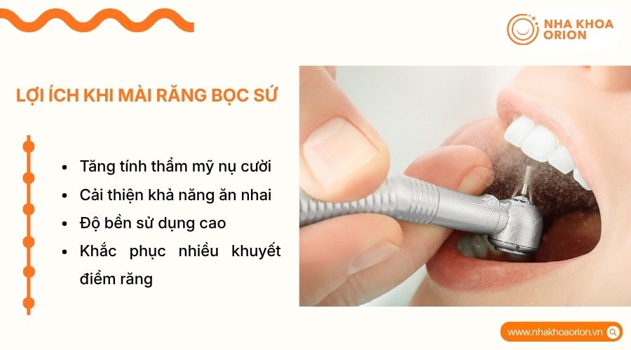 M&agrave;i răng gi&uacute;p tạo trụ vững chắc, hỗ trợ gắn m&atilde;o sứ ch&iacute;nh x&aacute;c v&agrave; thẩm mỹ