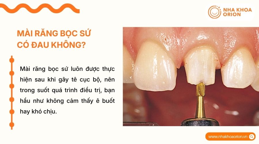 M&agrave;i răng bọc sứ thường kh&ocirc;ng đau do g&acirc;y t&ecirc; v&agrave; c&ocirc;ng nghệ hỗ trợ hiện đại