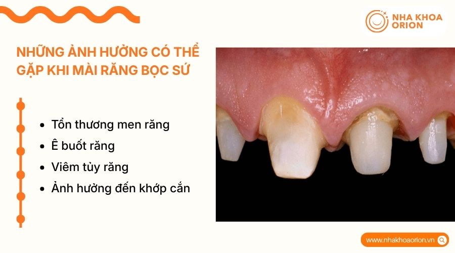 Một số ảnh hưởng c&oacute; thể gặp khi m&agrave;i răng nếu kỹ thuật kh&ocirc;ng chuẩn hoặc răng nhạy cảm