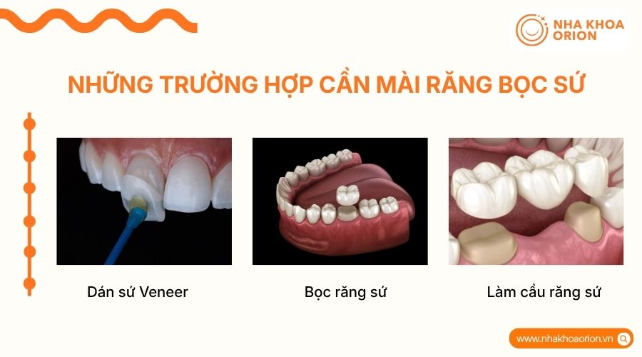 C&aacute;c phương ph&aacute;p phục h&igrave;nh răng sứ cần m&agrave;i răng gồm Veneer, bọc sứ v&agrave; cầu răng