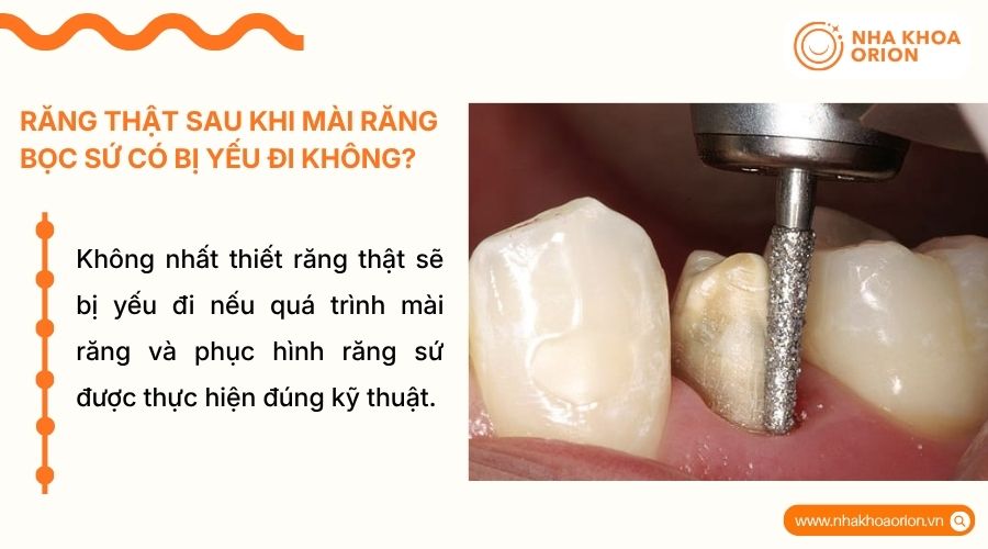 Răng thật kh&ocirc;ng yếu đi nếu m&agrave;i đ&uacute;ng kỹ thuật, chỉ t&aacute;c động lớp men v&agrave; ng&agrave; răng b&ecirc;n ngo&agrave;i