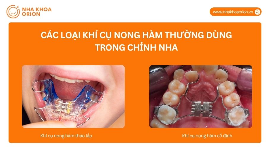 Kh&iacute; cụ nong h&agrave;m gồm loại th&aacute;o lắp v&agrave; cố định, t&ugrave;y t&igrave;nh trạng răng v&agrave; chỉ định b&aacute;c sĩ