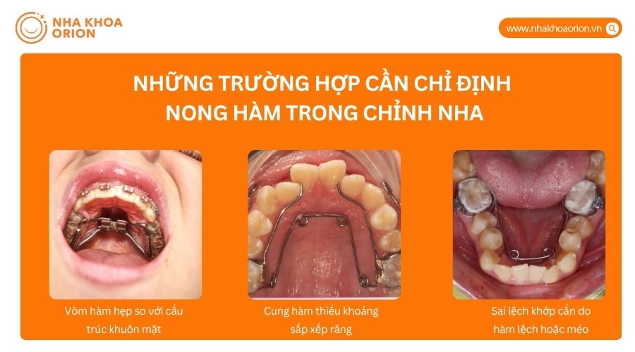 Nong h&agrave;m được chỉ định khi cung h&agrave;m hẹp, thiếu chỗ hoặc mất c&acirc;n đối với khu&ocirc;n mặt