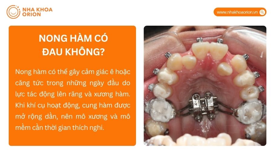 Nong h&agrave;m c&oacute; thể g&acirc;y &ecirc; hoặc căng tức nhẹ do lực t&aacute;c động l&ecirc;n răng v&agrave; xương h&agrave;m ban đầu