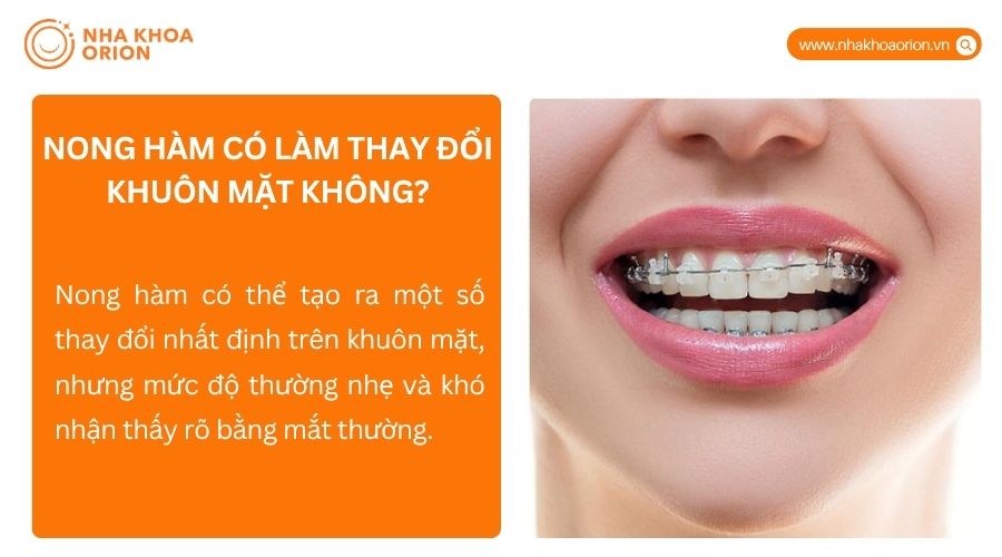 Nong h&agrave;m được chỉ định khi cung h&agrave;m hẹp, thiếu chỗ hoặc mất c&acirc;n đối với khu&ocirc;n mặt