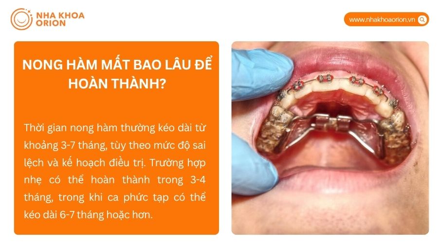 Thời gian nong h&agrave;m thường k&eacute;o d&agrave;i 3-7 th&aacute;ng t&ugrave;y mức độ sai lệch v&agrave; ph&aacute;c đồ điều trị