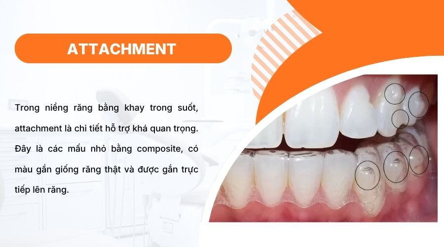 Attachment l&agrave; mấu composite gi&uacute;p tăng b&aacute;m, ổn định khay niềng khi dịch chuyển răng