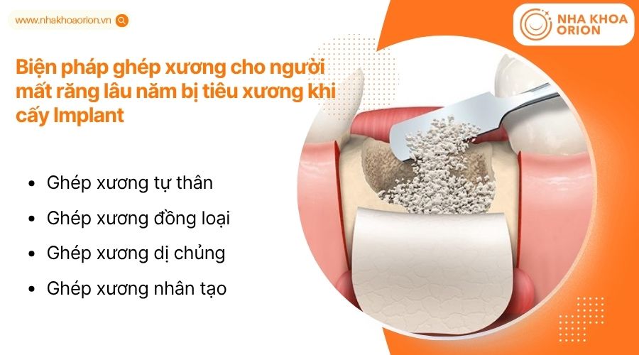 Gh&eacute;p xương gi&uacute;p phục hồi nền xương, tạo điều kiện cấy Implant ổn định v&agrave; bền vững