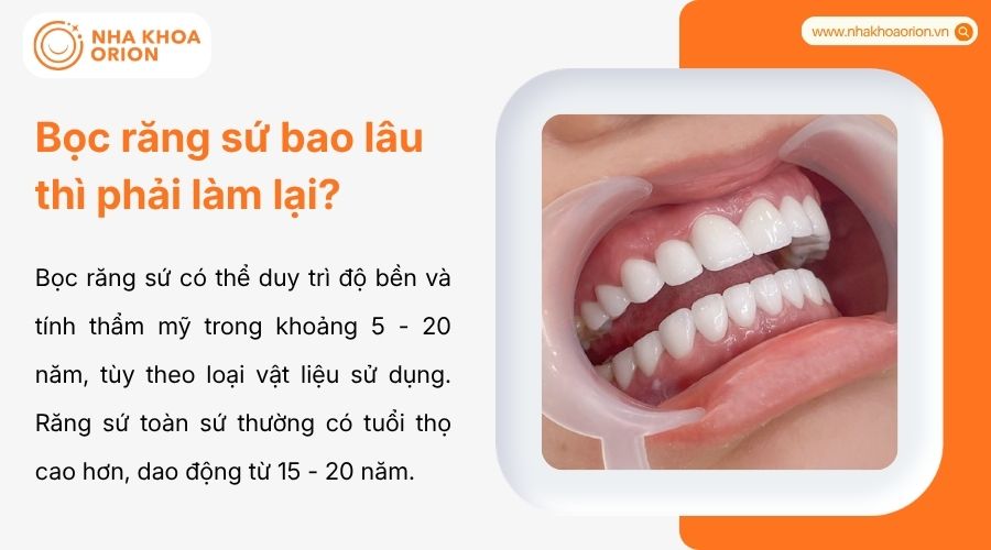 Tuổi thọ răng sứ dao động 5-20 năm t&ugrave;y loại v&agrave; c&aacute;ch chăm s&oacute;c