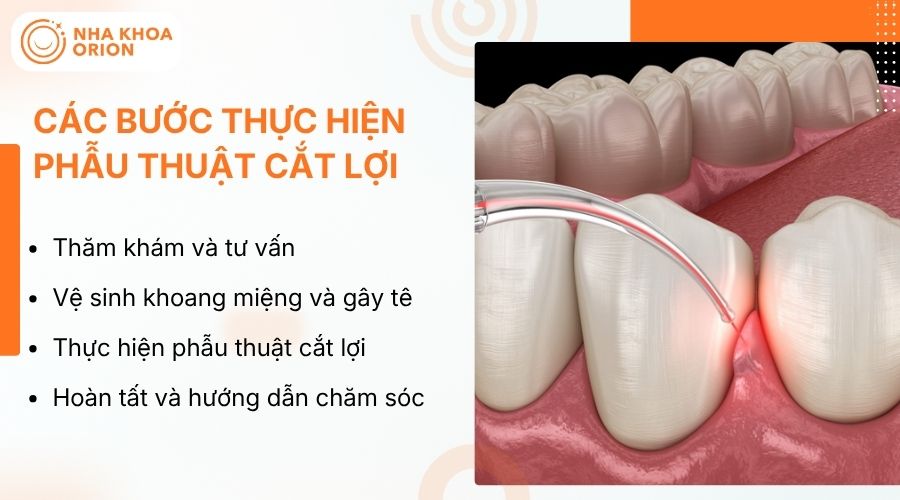 C&aacute;c phương ph&aacute;p cắt lợi đa dạng, ph&ugrave; hợp từng t&igrave;nh trạng v&agrave; nhu cầu điều trị