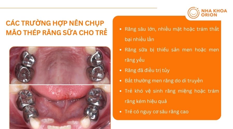 Chụp th&eacute;p răng sữa thường được chỉ định trong những trường hợp răng sữa bị tổn thương&nbsp;