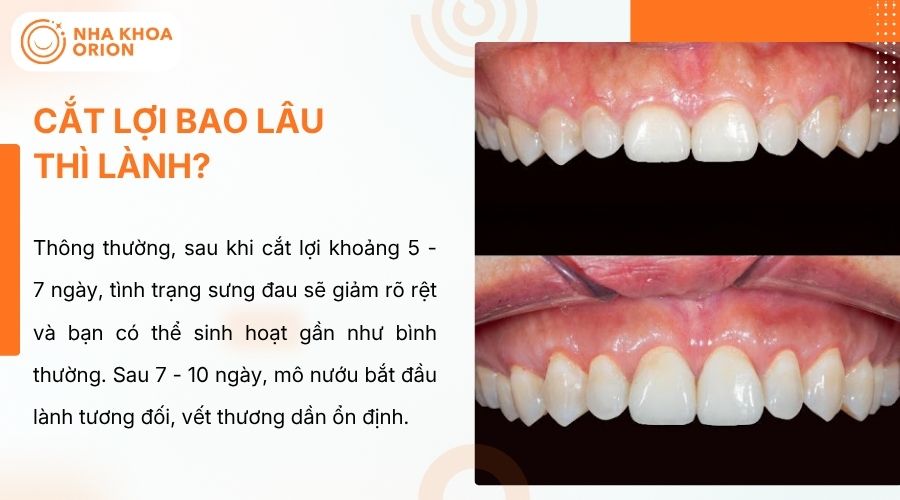 Nướu giảm sưng sau 5-7 ng&agrave;y, l&agrave;nh dần v&agrave; ổn định sau 3-6 th&aacute;ng