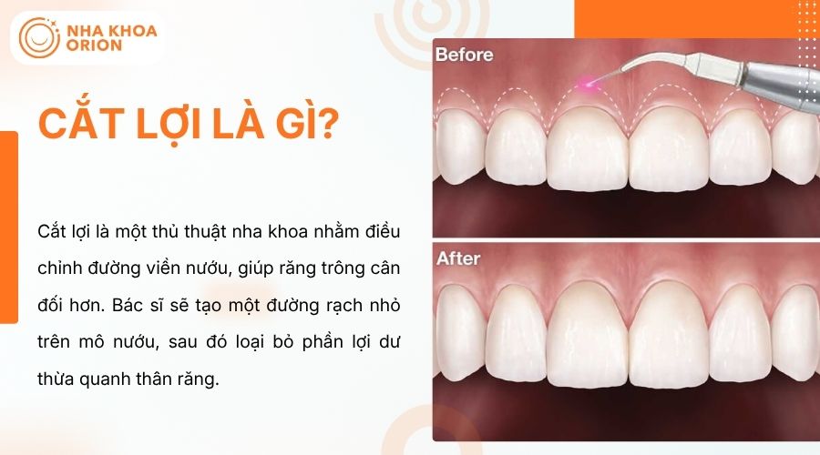 Cắt lợi gi&uacute;p điều chỉnh viền nướu, cải thiện thẩm mỹ nụ cười