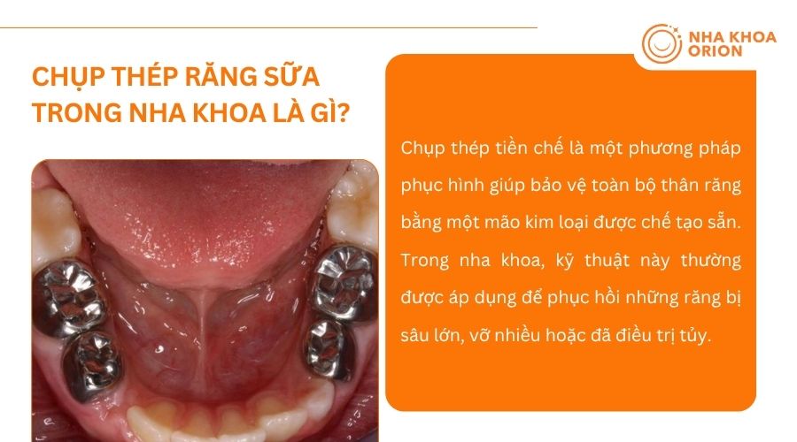 Chụp th&eacute;p răng sữa gi&uacute;p bảo vệ v&agrave; phục hồi răng sữa bị s&acirc;u hoặc vỡ hiệu quả