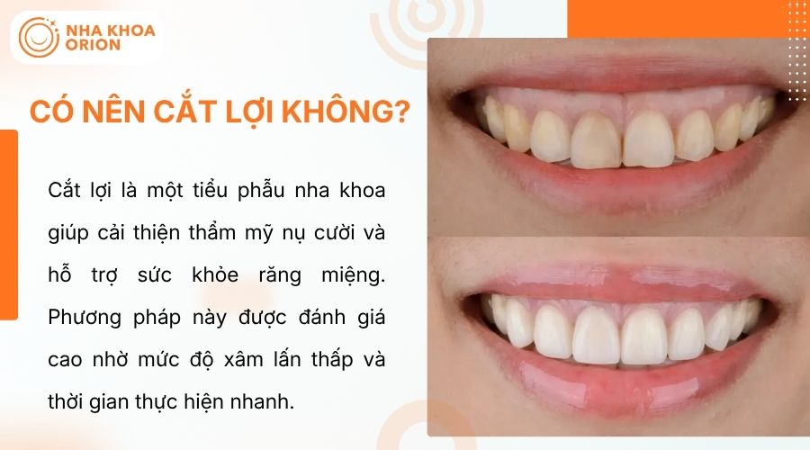 Cắt lợi gi&uacute;p nụ cười h&agrave;i h&ograve;a, &iacute;t x&acirc;m lấn v&agrave; hồi phục nhanh