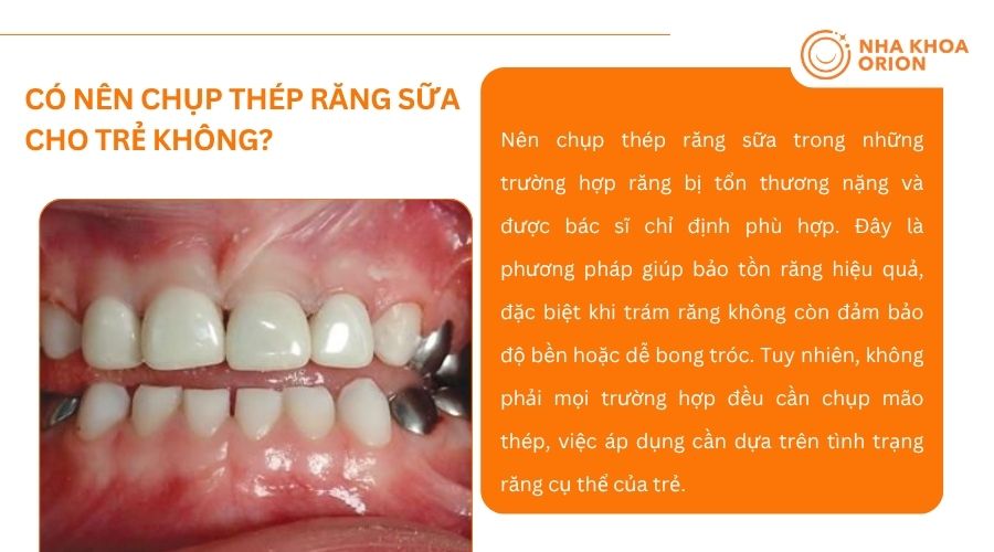 Chụp th&eacute;p răng sữa khi răng tổn thương nặng v&agrave; c&oacute; chỉ định từ b&aacute;c sĩ