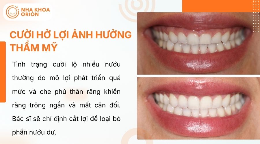 Cắt lợi gi&uacute;p cải thiện cười hở lợi, tăng c&acirc;n đối nụ cười