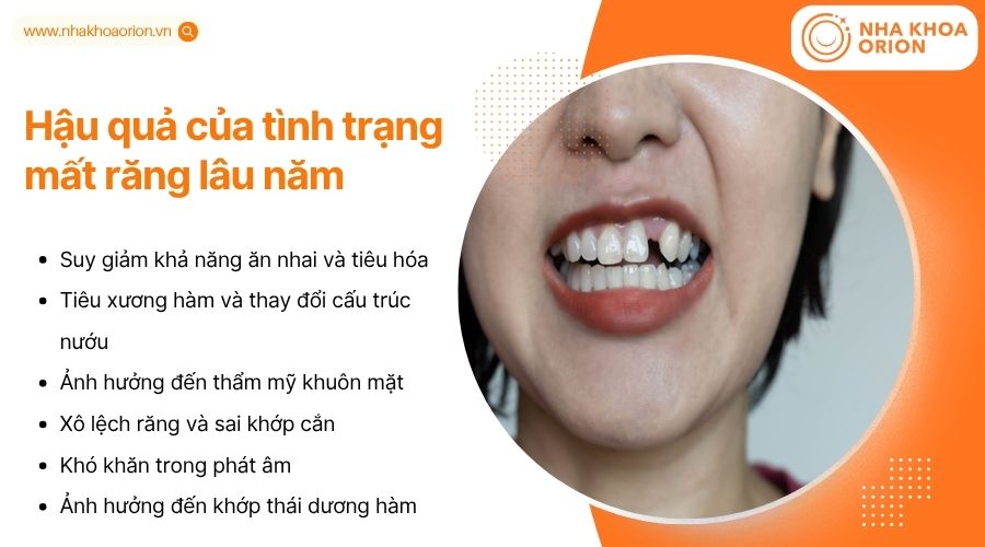Mất răng l&acirc;u năm ảnh hưởng ăn nhai, thẩm mỹ, khớp cắn, ph&aacute;t &acirc;m v&agrave; cấu tr&uacute;c xương h&agrave;m