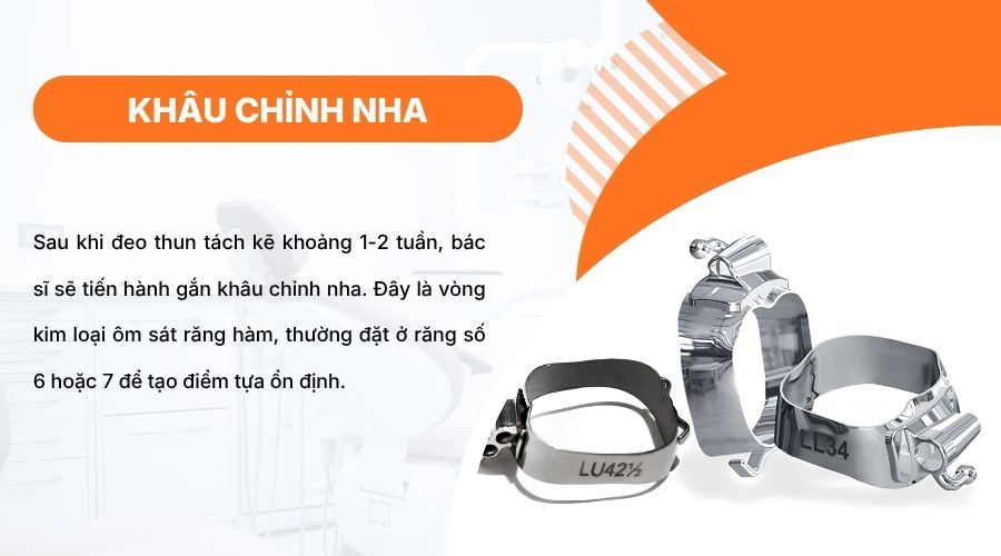 Kh&acirc;u chỉnh nha l&agrave; v&ograve;ng kim loại cố định, gi&uacute;p tạo điểm tựa vững chắc trong niềng răng