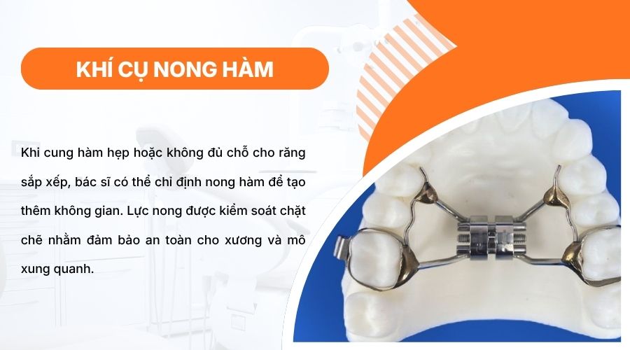 Kh&iacute; cụ nong h&agrave;m gi&uacute;p mở rộng cung h&agrave;m, tạo khoảng cho răng sắp xếp dễ d&agrave;ng hơn