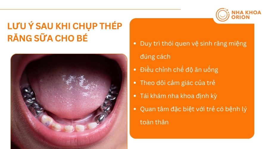 Chăm s&oacute;c đ&uacute;ng c&aacute;ch sau khi chụp m&atilde;o th&eacute;p gi&uacute;p răng b&eacute; bền l&acirc;u v&agrave; hạn chế biến chứng