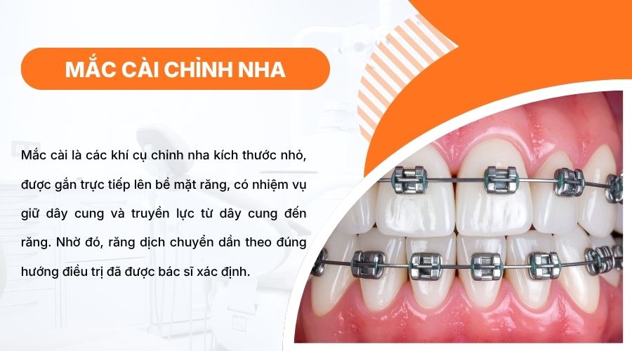 Mắc c&agrave;i gi&uacute;p cố định d&acirc;y cung v&agrave; tạo lực k&eacute;o gi&uacute;p răng dịch chuyển đ&uacute;ng hướng điều trị