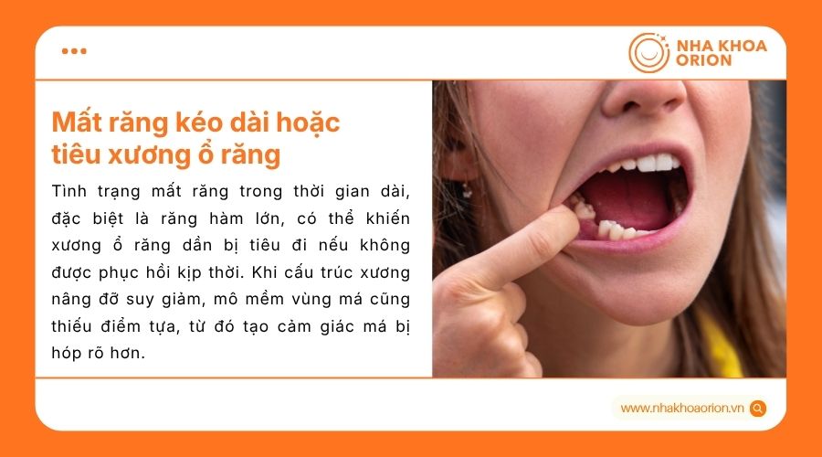 Ti&ecirc;u xương do mất răng hoặc khoảng trống nhổ răng c&oacute; thể l&agrave;m m&aacute; k&eacute;m đầy đặn hơn