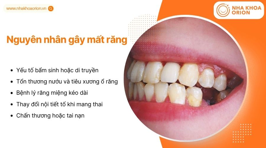 C&aacute;c nguy&ecirc;n nh&acirc;n g&acirc;y mất răng gồm bẩm sinh, bệnh l&yacute;, chấn thương v&agrave; thay đổi nội tiết tố