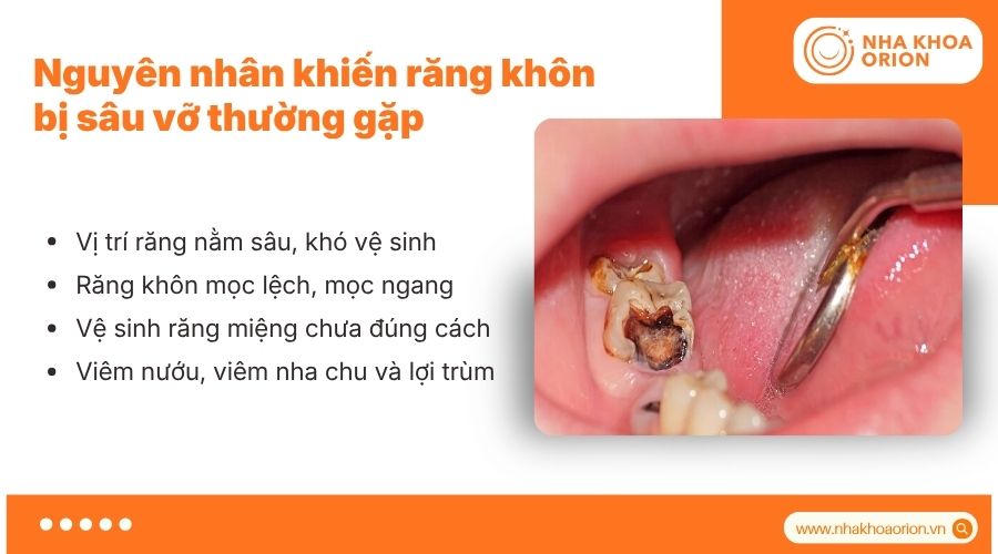 C&aacute;c dấu hiệu gi&uacute;p nhận biết răng kh&ocirc;n bị s&acirc;u sớm v&agrave; ch&iacute;nh x&aacute;c
