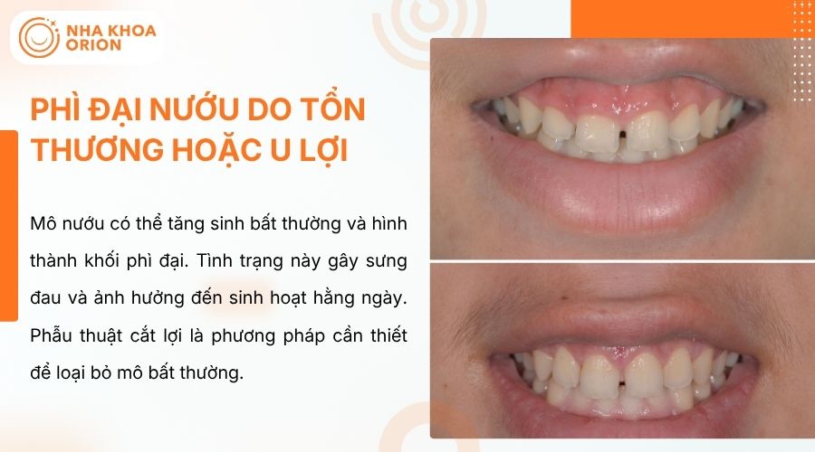 Cắt lợi loại bỏ m&ocirc; nướu ph&igrave; đại, giảm sưng đau hiệu quả