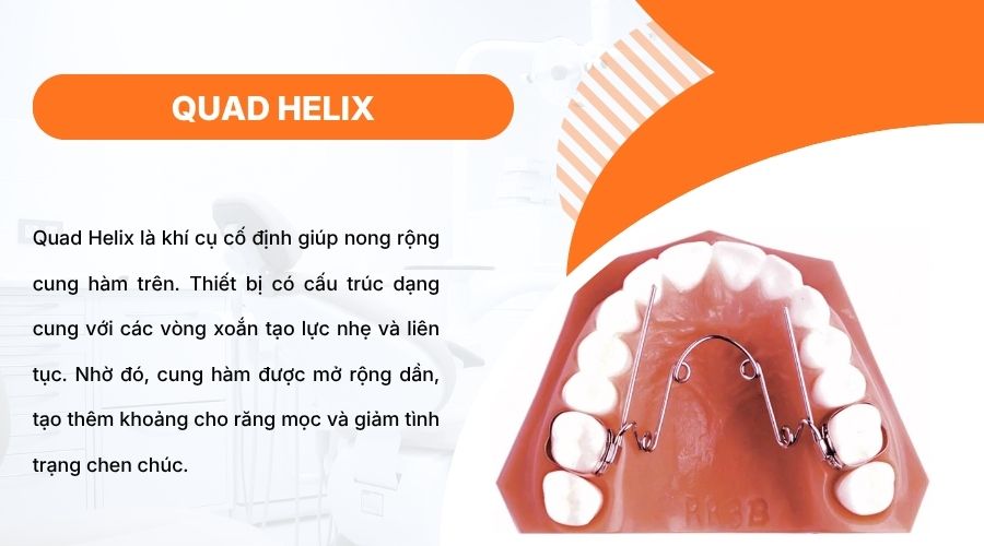 Quad Helix gi&uacute;p nong rộng cung h&agrave;m, tạo khoảng gi&uacute;p răng mọc v&agrave; sắp xếp đều hơn